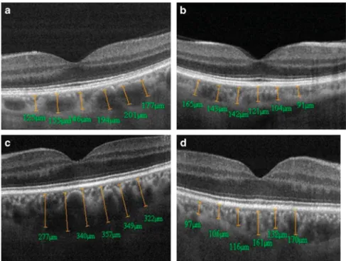 Figure 2 Choroidal thickness measurements by enhanced depth imaging optical coherence tomography in right eye (a) and left eye (b) of a patient with bilateral PEX syndrome and in the unaffected eye (c) and affected eye (d) of a patient with unilateral PEX 