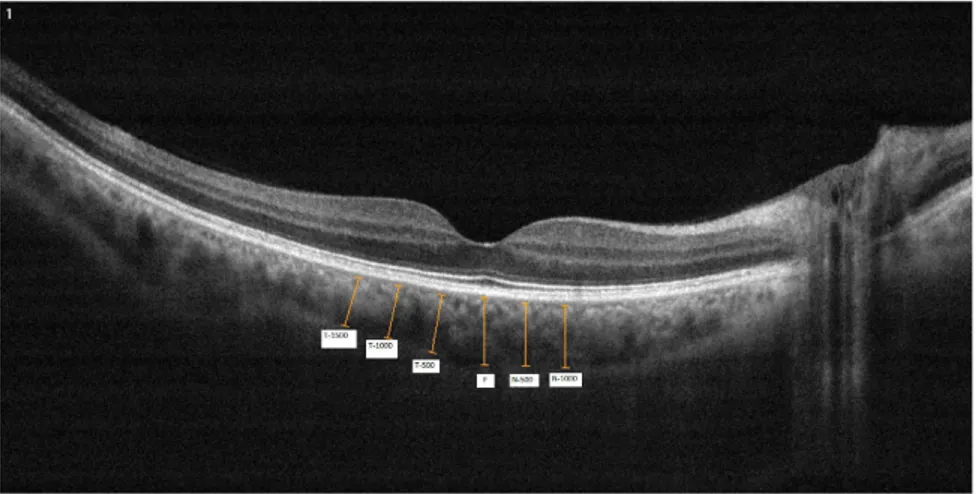 Figure 1 Example of choroidal thickness measurements. T-1500: Choroidal thickness at 1500 mm temporal to the fovea; T-1000: Choroidal thickness at 1000 mm temporal to the fovea; T-500: Choroidal thickness at 500 mm temporal to the fovea; F: Choroidal thick