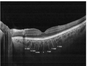 Figure 1 Choroidal thickness measurements of a patient T-1500: Choroidal thickness at 1500 滋m temporal to the fovea; T-1000: Choroidal thickness at 1000 滋m temporal to the fovea; T-500: Choroidal thickness at 500 滋m temporal to the fovea; F: Choroidal thic