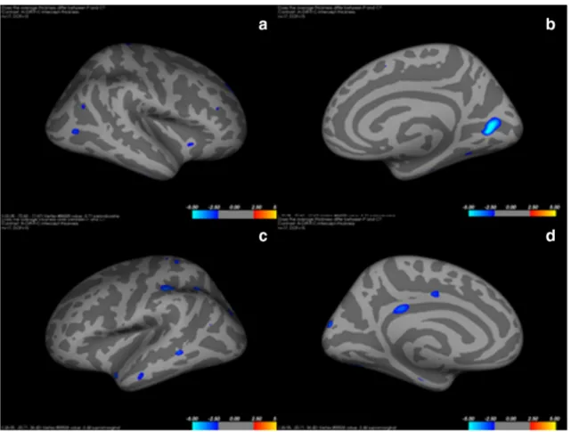 Fig. 1 Lateral (a) and medial (b) views of an inflated right hemisphere showing regions of cortical thinning (blue clusters)