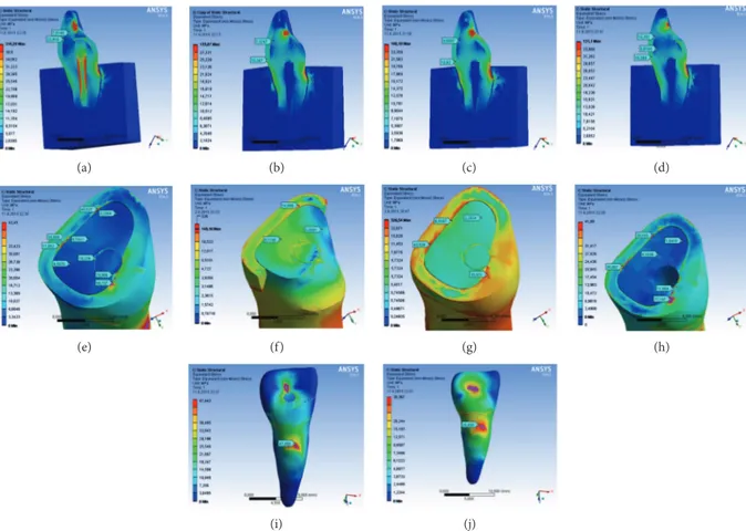 Figure 2: (a) At the tooth structure, the highest maximum von Mises stress values were observed in model BP for enamel