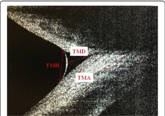 Fig. 1 Image of measurement of tear meniscus height, tear meniscus depth and tear meniscus area using anterior  segment-optical coherence tomography