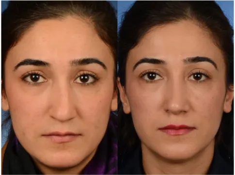 Figure 4 Partially corrected high dorsal deviation. Preoperative (left) and postoperative (right) frontal view of the patient are shown