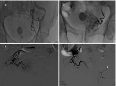 Şekil 1.  a) Yetmiş sekiz yaşında erkek hastada sol ana internal  ilak arteriogramlarda internal ilak arterin karmaşık anatomisi  izlenmektedir