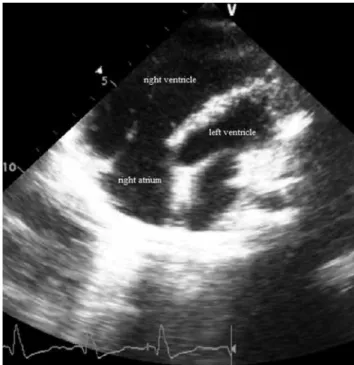 Figure 1.  Two-dimensional  echocardiographic  view  of  a  preoperative-pulmonary valve replacement patient.