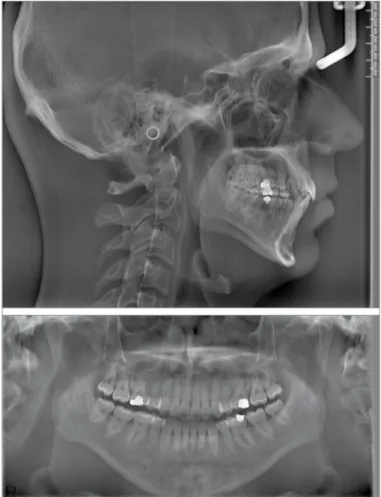 Figure 4. Post-treatment panoramic and lateral cephalometric films 