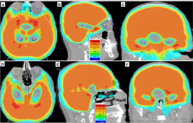 Figure 1. Dose color wash images of a patient receiving 25 Gy of prophylactic cranial irradiation dose utilizing by helical tomotherapy;  A