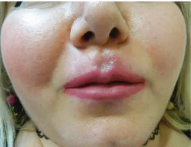 Figure 1a. Sclerotic plaques restricting mouth movements  in a patient with scleredema due to vitamin E injection