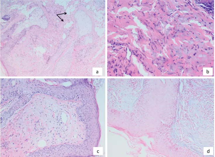 Figure 2. a) Histopathology shows fat tissue surrounding the sweat glands in mid dermis (arrows), b,c) thickened and  fenestrated collagen bundles in the dermis, d) Alcian blue positive mucin structures (a, H&amp;E x100; b and c, H&amp;E x200; d,  Alcian b