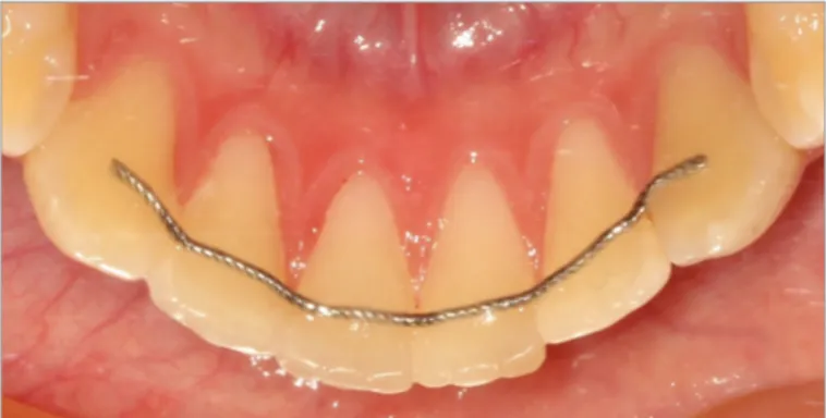 Figure 1. 5-stranded wire retainer bonded to all anterior teeth from 