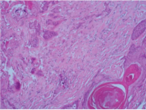 Figure 1. Atypical squamous cells have ke- ke-ratinization that infiltrating desmoblastic  stroma (H&amp;E, ×100).