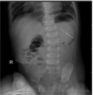 Fig.  2:  Computerized  tomography  shows  a  needle,  32 