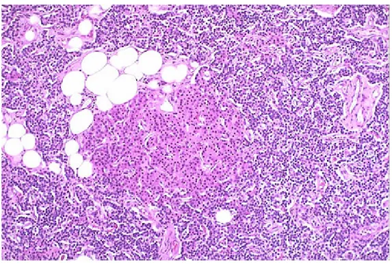 Şekil 2.2B: Paratiroid hiperplazisi; adipoz doku yok denecek kadar az ancak  normal paratiroid hücrelerinin bir kısmı duruyor, oksifil hücreler pembeye  boyanmış