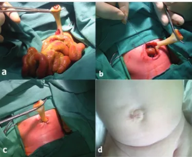 Figure  1.  Primary  closure  for  gastroschisis.  (a)  Reduction 
