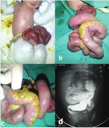 Figure 3. (a, b, c) One patient with complex gastroschisis 