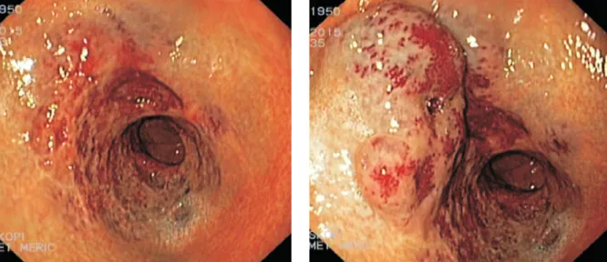 Figure 1. Endoscopic view of the lesion located in the stomach Figure 2. Mass-like appearance on endoscopy