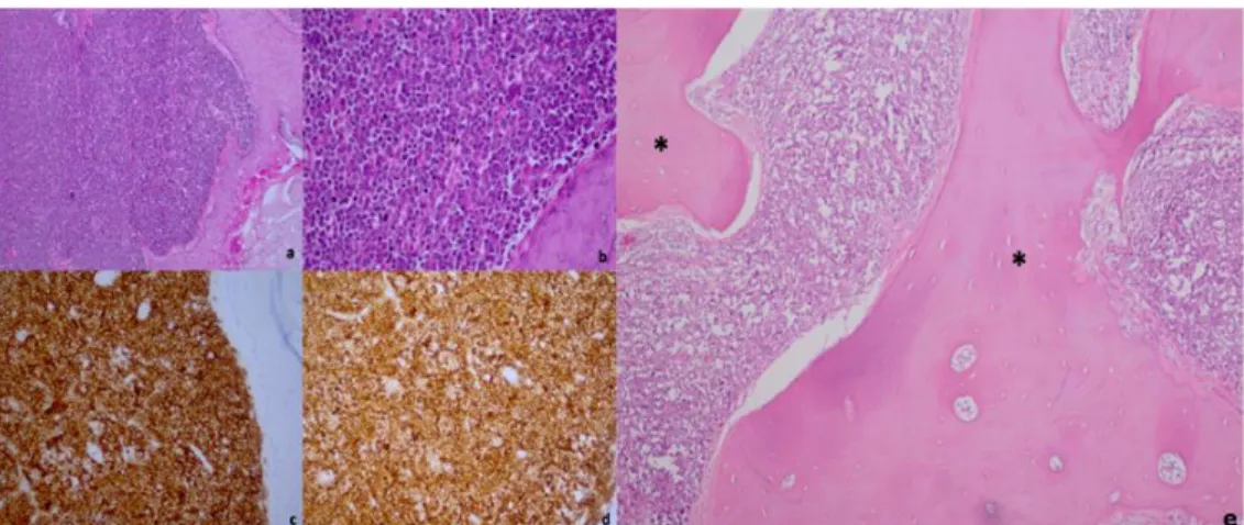 Figure 2. Histopathology. The set of microphotopgraph as reveals diffuse cutaneousin filtration (a)  composed of medium sized cells some with round to oval nuclei that have finely dispersed chromatinand  small nucleolei (b).The neoplastic cells were diffus