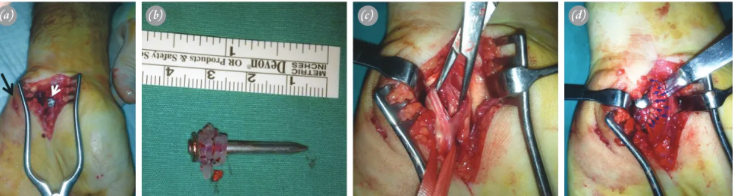 Fig. 2.  (a) Black arrow: Nail entry hole at the hypothenar region; white arrow: Nail