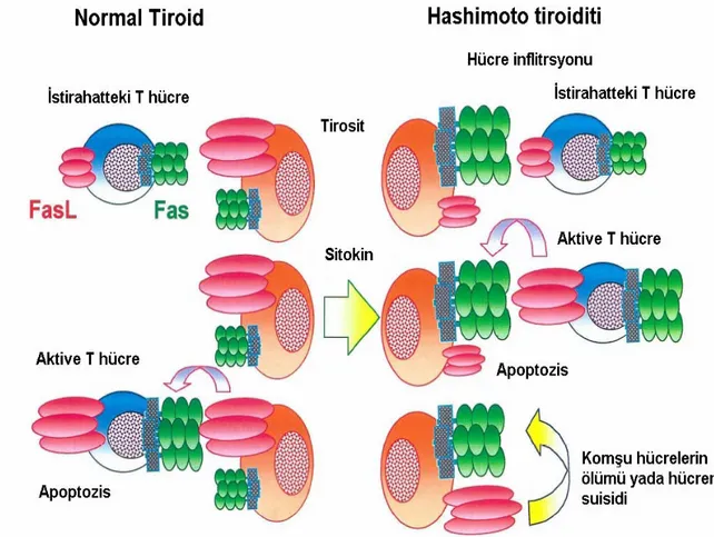 Şekil 1: Hashimoto tiroiditi ve normal tirositte Fas/FasL’nın rolü 