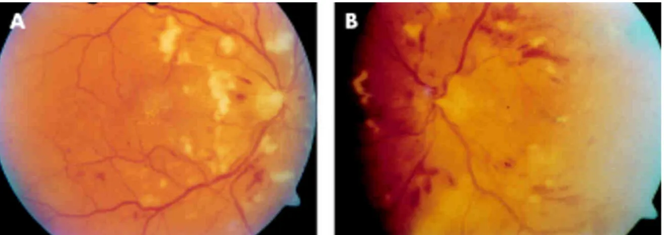 Şekil 2.2.A/ B. Đnterferon retinopatisi fundus fotoğrafı 18