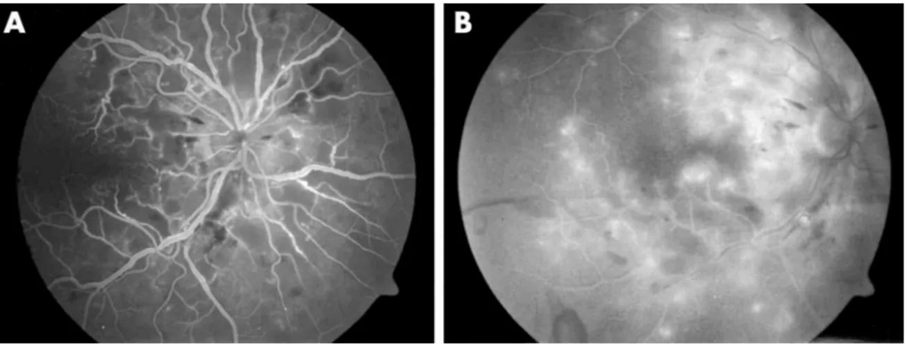Şekil 2.3. A/ B. Đnterferon retinopatisi fundus floresein anjiografisi  18