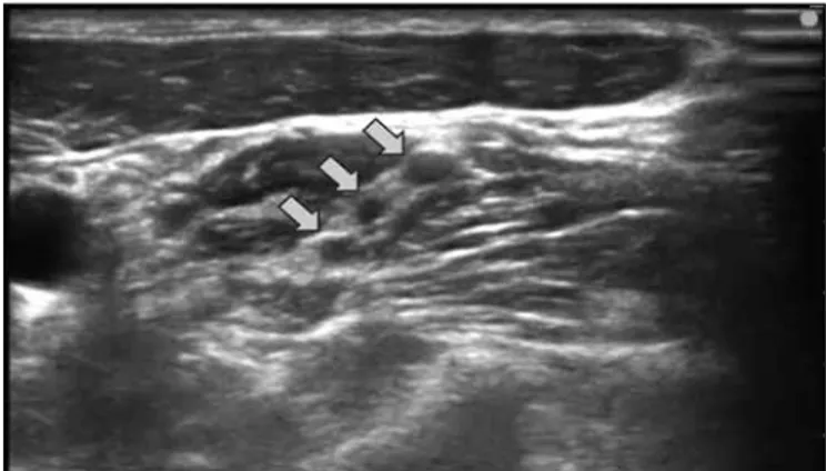Figure 4: Ultrasound image of the brachial plexus in the intersca- intersca-lene groove (nerve roots marked by arrows)