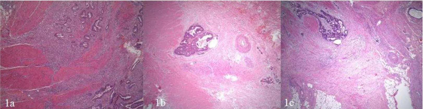 Figure 1: Grading the desmoplastic stromal response based on the amount of the collagen around the tumor islands; a) Grade 1 (H&amp;E x40), b) Grade 2 (H&amp;E x40), c) Grade  3 (H&amp;E x25)