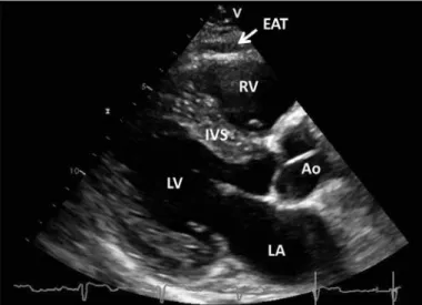 Figure 1. Transthoracic echocardiographic view of epicardial adipose  tissue. Epicardial adipose tissue is an echo-lucent area between  epicardial surface and parietal pericardium in front of the right  ventricular free wall and is pointed by a white arrow