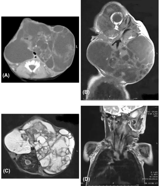 Figure 2 (A) Axial computed tomography revealed an 8 cm  13 cm  7 cm diameter cystic mass that extended from the subcutaneous fat tissue on the left maxilla to bilateral submandibular area and to the anterior chest wall through the anterior part of the t