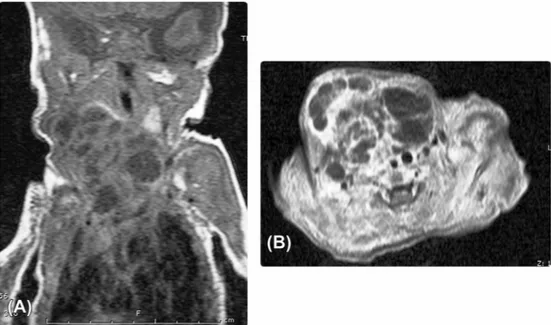 Figure 4 (A) Coronal T1-weighted magnetic resonance imaging revealed 5 cm  3.5 cm-diameter multiloculated cyst which is hypointense on the T1-weighted image extending from the right hypopharynx eparapharyngeal space to the caudal anterior midline, submand