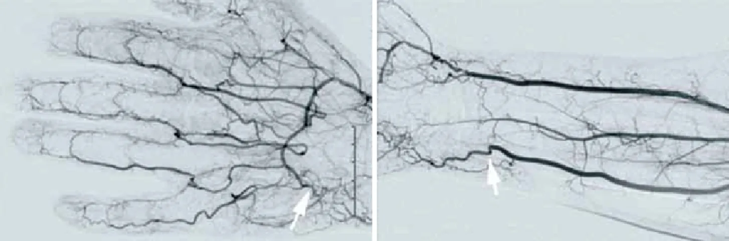 Figure 1. Upper extremity angiography: a stenosis or occlusion (arrows) is visible at Guyon canal.