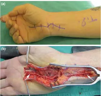 Figure 3.  (a)  Intraoperative view of thrombozed ulnar artery  of a patient with hypothenar hammer syndrome,  (b)  excised  thrombozed segment and  (c) ulnar artery after reconstruction.