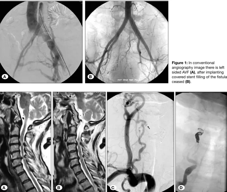 Figure 1: In conventional  angiography image there is left  sided AVF (A), after implanting  covered stent filling of the fistula  ceased (B)