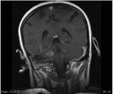Figure 1. Contrast enhanced T1 weighted image revealed multiple,  expansive hypointense lesions with contrast enhancements (Patient 1;  Acute demyelinating encephalomyelitis (ADEM)-like picture due to primary  Sjogren’s Syndrome)