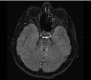 Figure 3. T2 weighted MRI images showed hyperintense lesion from  medullar to C1 region (Patient 8; Multiple Sclerosis-like illness due to  primary Sjogren’s Syndrome)