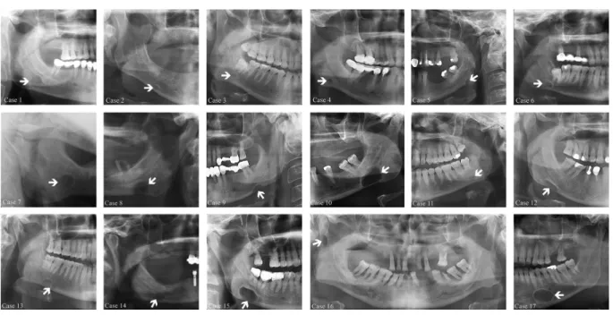 Figure 1. Cropped panoramic radiographs (case 1-6, and 8-17) and lateral oblique mandible projection (case 7) demonstrates various size, location, and types of the Stafne bone cavity (SBC) (arrows).