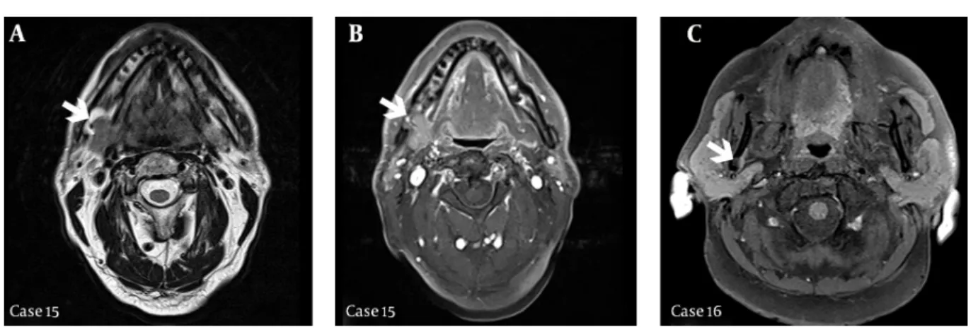 Figure 3. Post contrast spin echo (SE) (3540/91, TR-TE) MRI axial section (case 15-a) and post contrast SE (385/8.7, TR-TE) with fat suppression MRI axial section (case 15-b) demon- demon-strates the bony defect containing an extension of tissue from the s