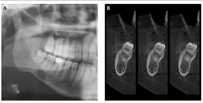 Figure 4. A, Panoramic radiograph demonstrates diffuse radiolucency similar to Stafne bone cavity (SBC) that is located in the right posterior mandible, below the inferior