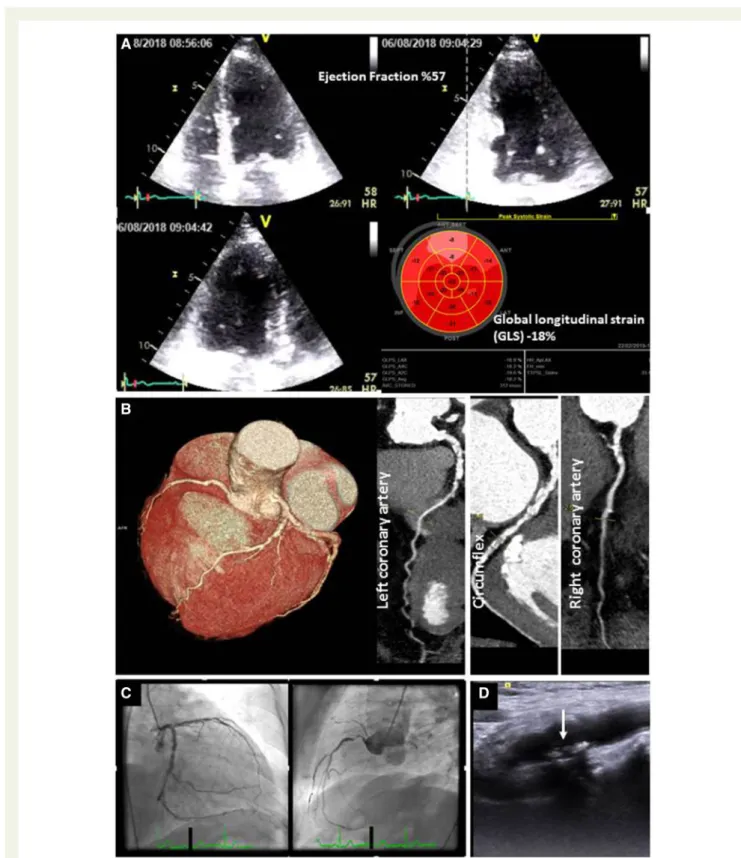 Figure 1 A 48-year-old women, suffering from rheumatoid arthritis for 10 years, apparently asymptomatic with severe functional disability due to joint pain and no traditional risk factors for atherosclerosis (A)