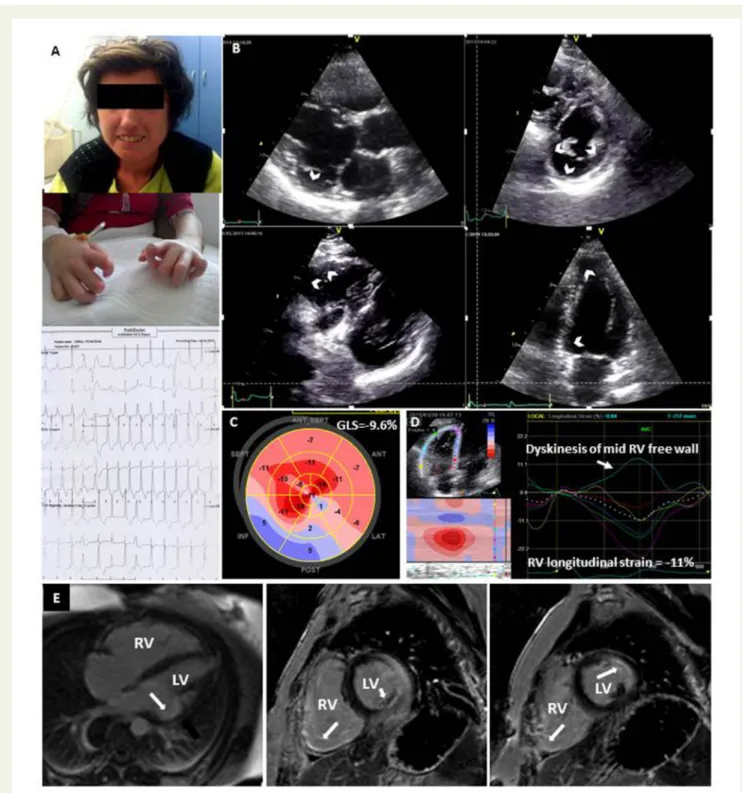 Figure 2 (A) A 36-year-old women with palpitation, suffering from systemic sclerosis for 15 years, had multiple episodes of non-sustained ventricu-