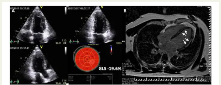 Figure 4 Lupus myocarditis in a 32-year-old woman with chest pain, arrhythmias, elevated C-reactive protein, troponins, and normal coronaries.