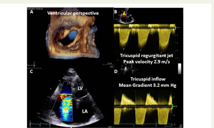 Figure 6 Lupus valvulitis. (A) Thickened, fibrotic, retracted tricuspid leaflets with (B, C) severe regurgitation and (D) mild stenosis
