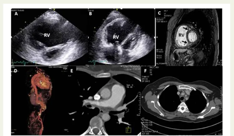 Figure 7 A 44-year-old woman with Takayasu’s arteritis. Cardiac involvement is secondary to pulmonary hypertension which is caused by pul- pul-monary vasculitis