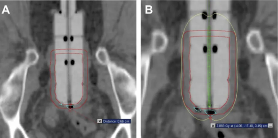 Figure 1. (a) Axial CT images of the vagina with a cylinder inserted demonstrating a small air pocket and (b) point dose calculation of the dose to the vaginal mucosa, where the prescribed dose was 4 Gy per fraction