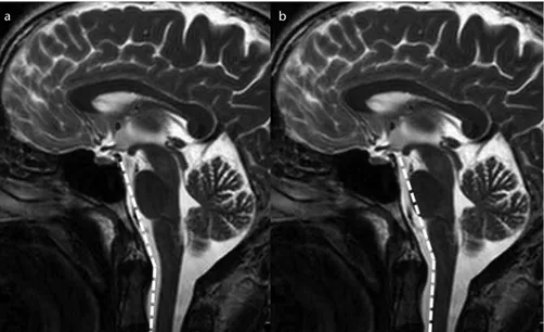 Figure 1. a, b. T2-weighted mid-sagittal images show the normal craniovertebral angle (a)  and normal cervicomedullary angle (b).