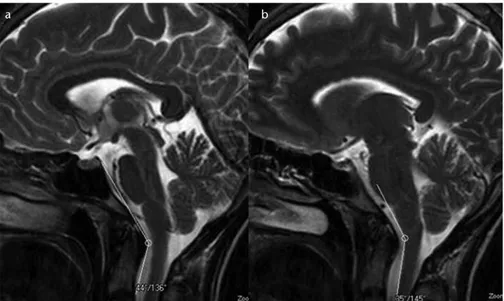 Figure 3. a, b. T2-weighted mid-sagittal images show the narrowed craniovertebral (a) and  cervicomedullary (b) angles in a patient with a pain score of 3.