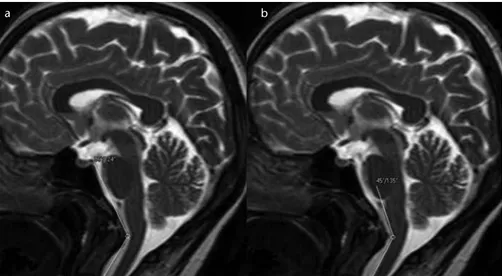 Figure 4. a, b. T2-weighted mid-sagittal images show the prominently narrowed  craniovertebral (a) and cervicomedullary (b) angles in a patient with a pain score of 4.