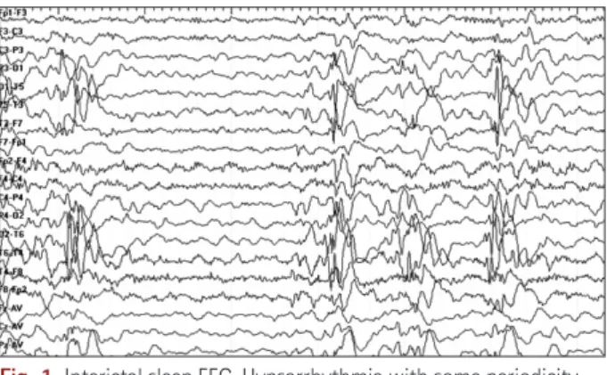 Fig. 1.  Interictal sleep EEG. Hypsarrhythmia with some periodicity.