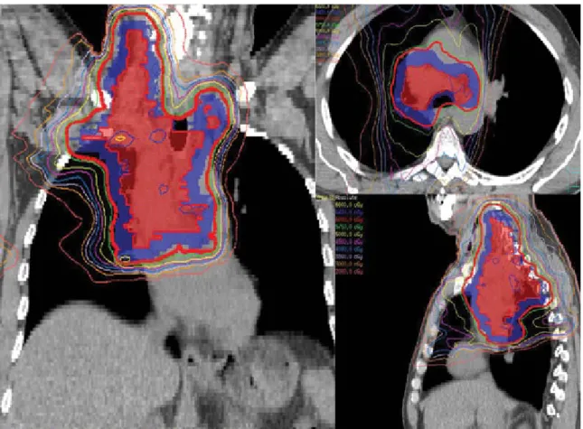 FIG. 1. IMRT with a definitive dose of 60 Gy to the PTV in 30 fractions using a 4D-CT-based ITV approach for a NSCLC patient with T4N3M0 disease.