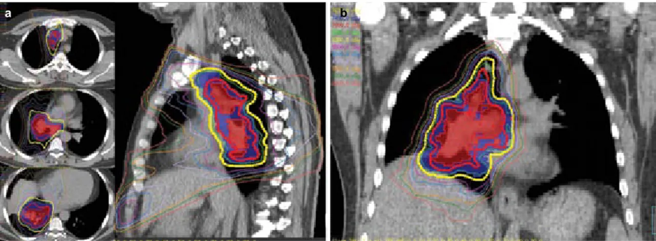 FIG. 3. a, b. IMRT-based simultaneous integrated boost to 70 Gy (2 Gy/fraction/day) to integrated gross tumor volume while keeping the conventional 